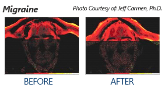 These thermal images were taken before and after a single HEG Neurotherapy training session. Brighter colors are hotter - you can see heat resulting from the brain's increase in activity.