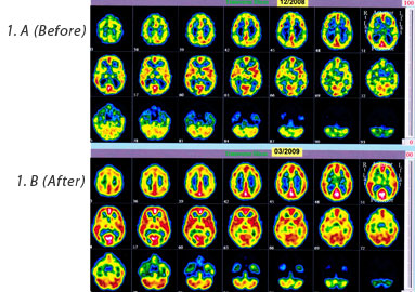 Drug abuse/brain damage before and after 17 HEG neurofeedback sessions. On each image, the 1st and 3rd rows are before HEG and the 2nd and 4th rows are after.