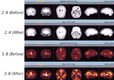 Drug abuse/brain damage before and after 17 HEG neurofeedback sessions. On each image, the 1st and 3rd rows are before HEG and the 2nd and 4th rows are after.